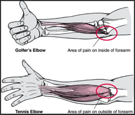 Prevent and Treat Climber’s Elbow